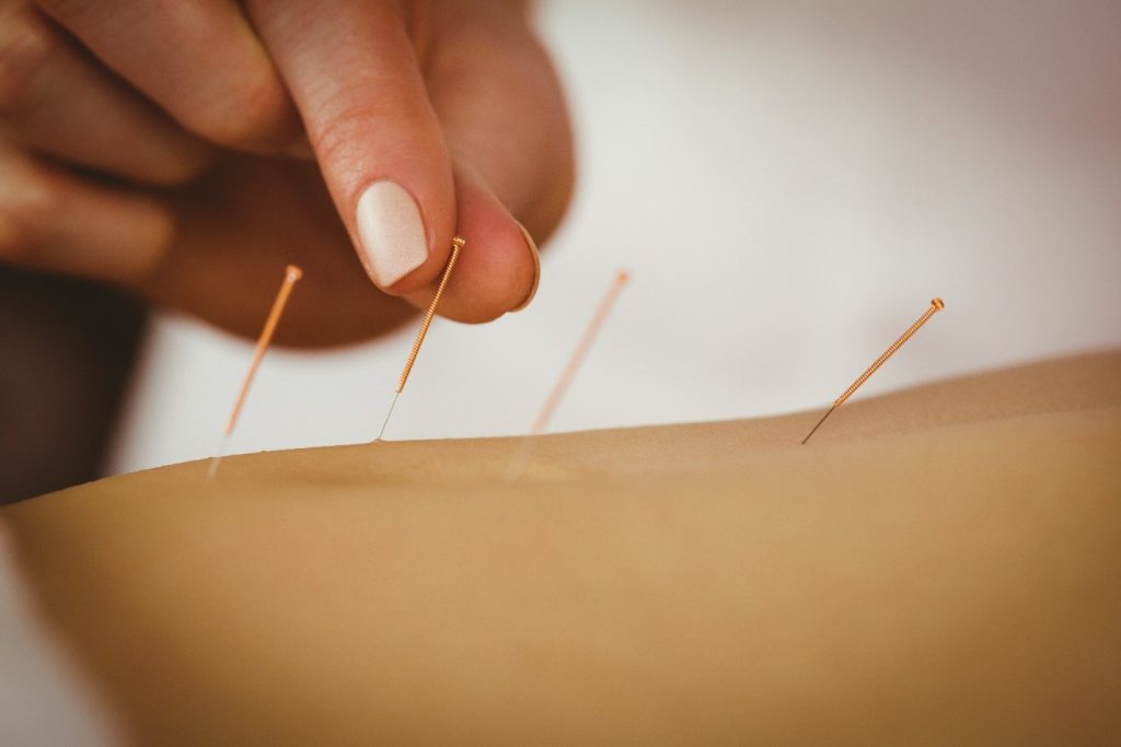A patient at Uplift Recovery getting acupuncture for addiction recovery